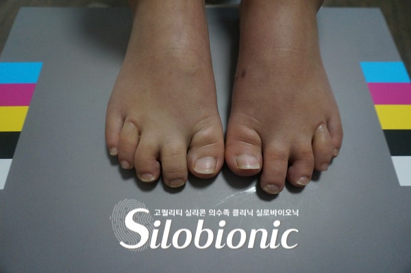 표준 컬러차트 위에 선 두 발, 짧은 네 번째 발가락에 실리콘 발가락 의족 착용
