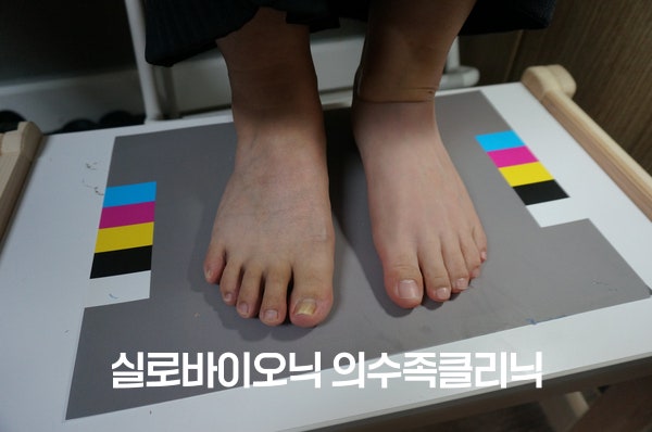 표준 컬러차트 위에 선 두 발, 오른쪽이 실리콘 발 의족