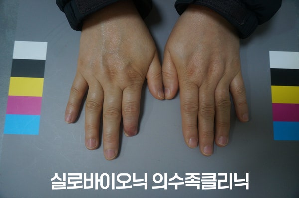 표준 컬러차트 옆에 놓인 두 손, 실리콘 손가락 의수 착용