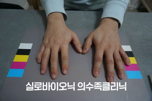표준 컬러차트 위에 올린 두 손, 오른손 손가락에 실리콘 의수 착용