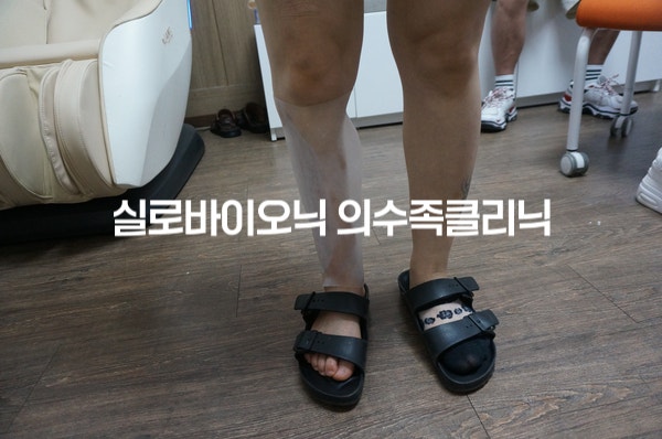 샌들을 신고 선 두 다리, 한쪽 종아리에 투명한 체크소켓 착용