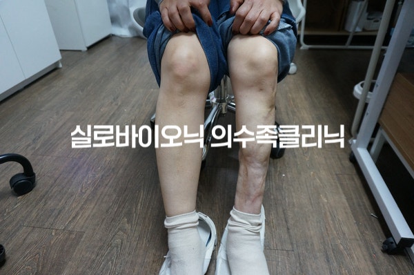 의자에 앉은 두 다리, 한쪽 종아리 안쪽이 움푹 꺼진 모습