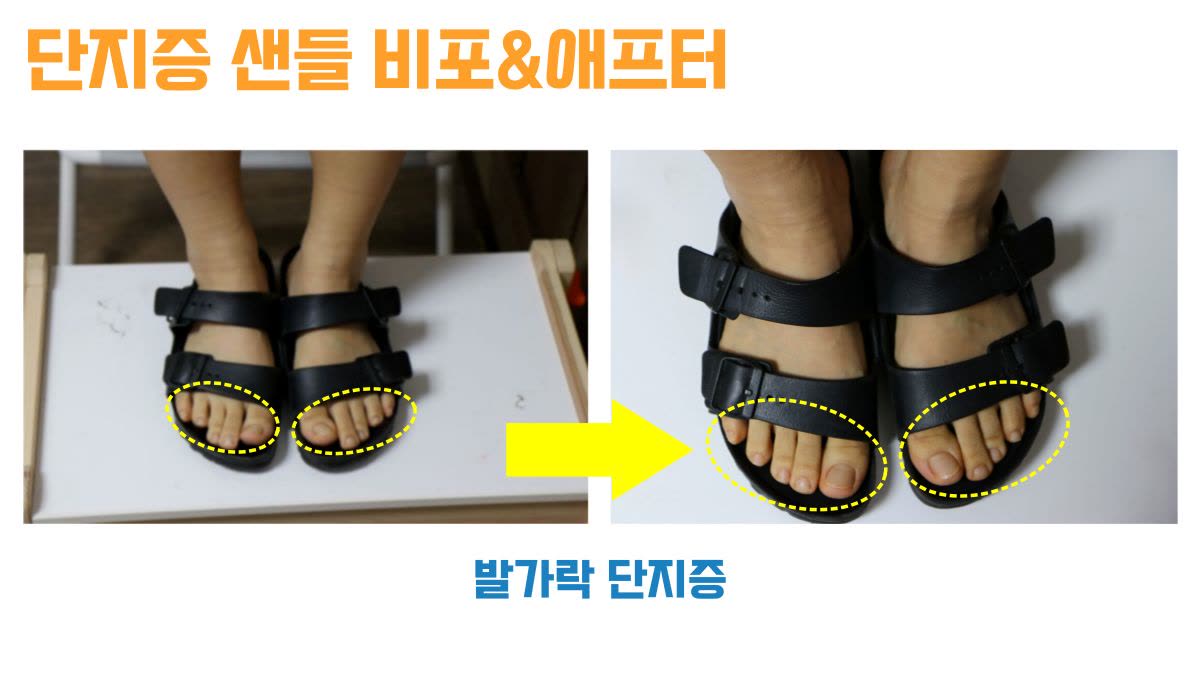 단지증 · 샌들을 신었을 때