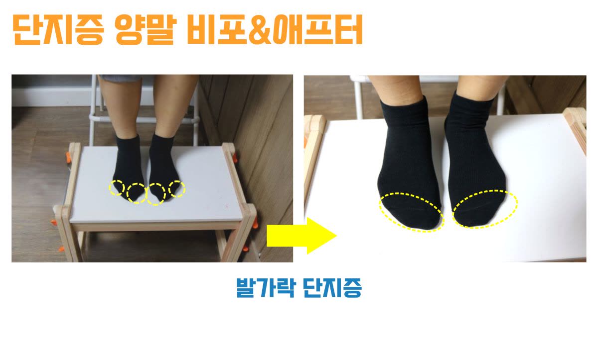 단지증 · 양말을 신었을 때